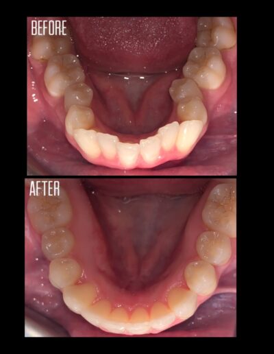 Invisalign before and after