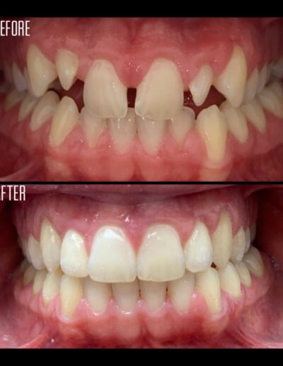 Invisalign before and after